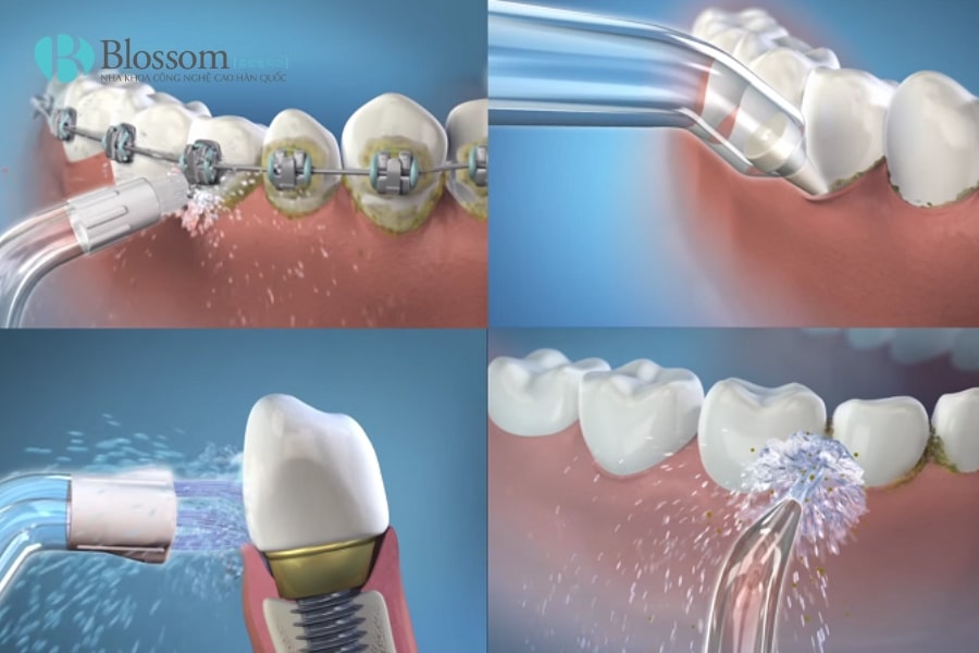 Hướng dẫn cách sử dụng tăm nước đúng cách, hiệu quả và an toàn cho răng miệng 5 su dung tam nuoc 5 min