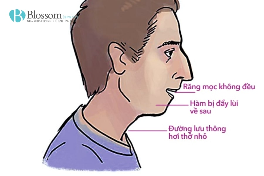 Thở bằng miệng có tốt không? Nguyên nhân, tác hại và cách khắc phục hiệu quả 1 tho bang mieng 1 min