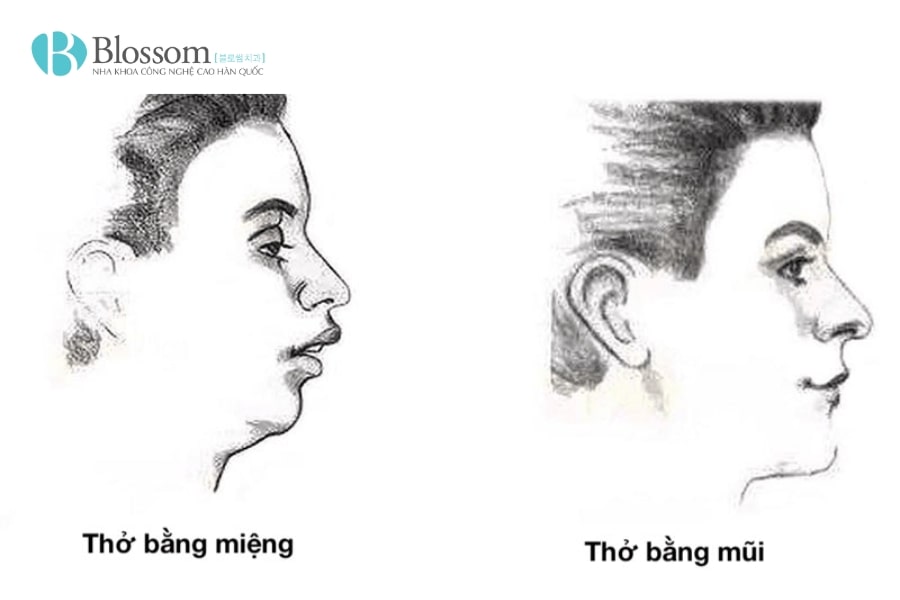 Thở bằng miệng có tốt không? Nguyên nhân, tác hại và cách khắc phục hiệu quả 2 tho bang mieng 2 min