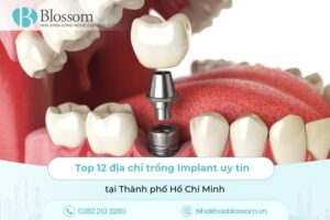 Top 12 địa chỉ trồng Implant uy tín tại TP.HCM