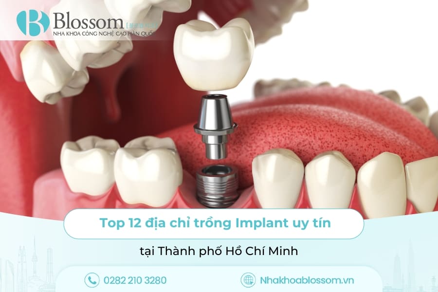 Top 12 địa chỉ trồng Implant uy tín tại TP.HCM