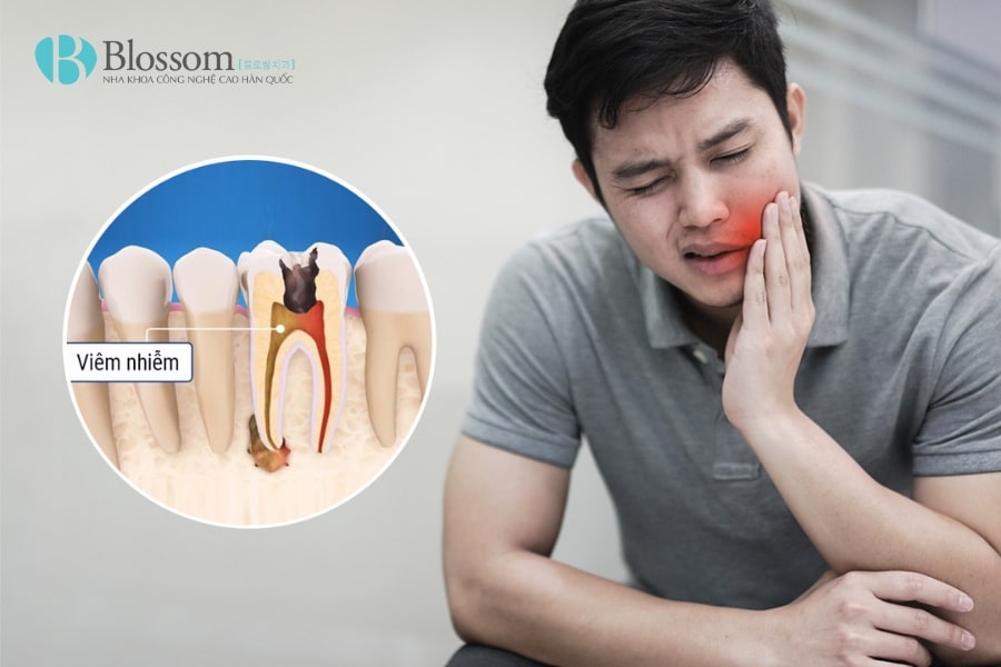 Bật mí mẹo trị nhức răng đơn giản giúp giảm đau tức thì tại nhà 5 tri nhuc rang 5 min