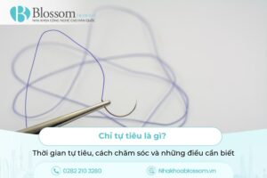 Chỉ tự tiêu là gì? Thời gian tự tiêu, cách chăm sóc và những điều cần biết