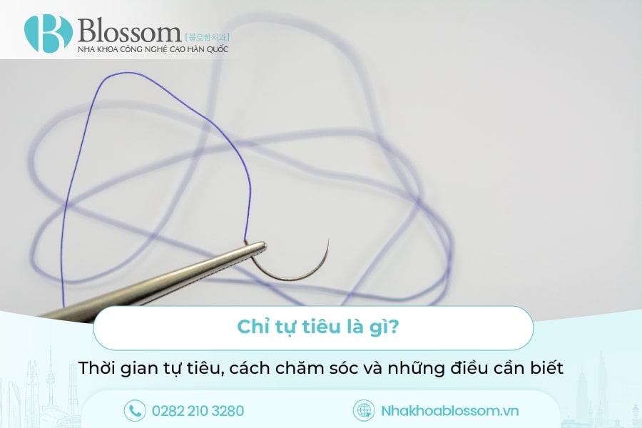 Chỉ tự tiêu là gì? Thời gian tự tiêu, cách chăm sóc và những điều cần biết