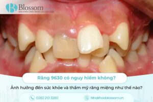 Răng 9630 có nguy hiểm không? Ảnh hưởng đến sức khỏe và thẩm mỹ răng miệng như thế nào?