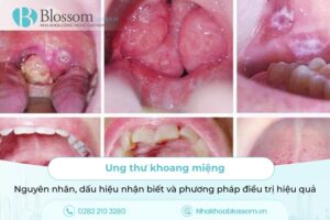 Ung thư khoang miệng: Nguyên nhân, dấu hiệu nhận biết và phương pháp điều trị hiệu quả