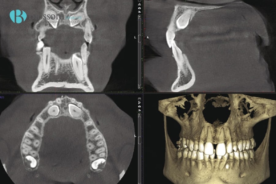 Chụp CT Cone Beam – Giải pháp hình ảnh 3D chính xác trong nha khoa 1 chup ct cone beam 1 min