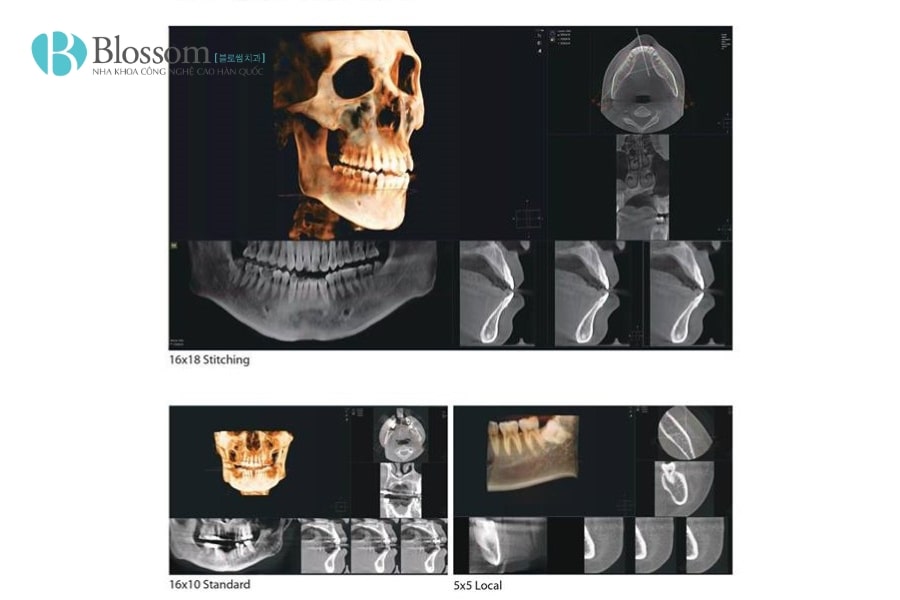 Chụp CT Cone Beam – Giải pháp hình ảnh 3D chính xác trong nha khoa 2 chup ct cone beam 2 min
