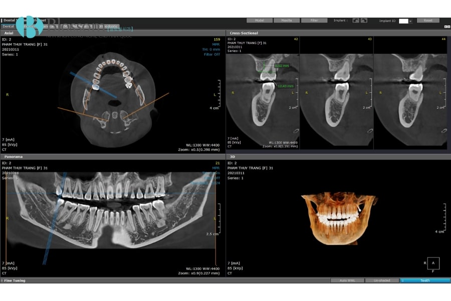 Chụp CT Cone Beam – Giải pháp hình ảnh 3D chính xác trong nha khoa 3 chup ct cone beam 3 min