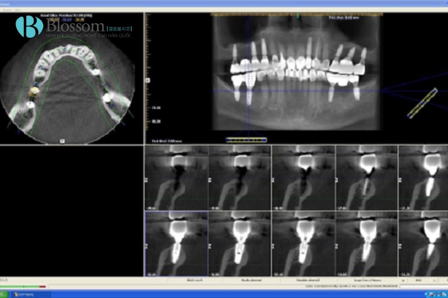 Chụp CT Cone Beam – Giải pháp hình ảnh 3D chính xác trong nha khoa 4 chup ct cone beam 4 min