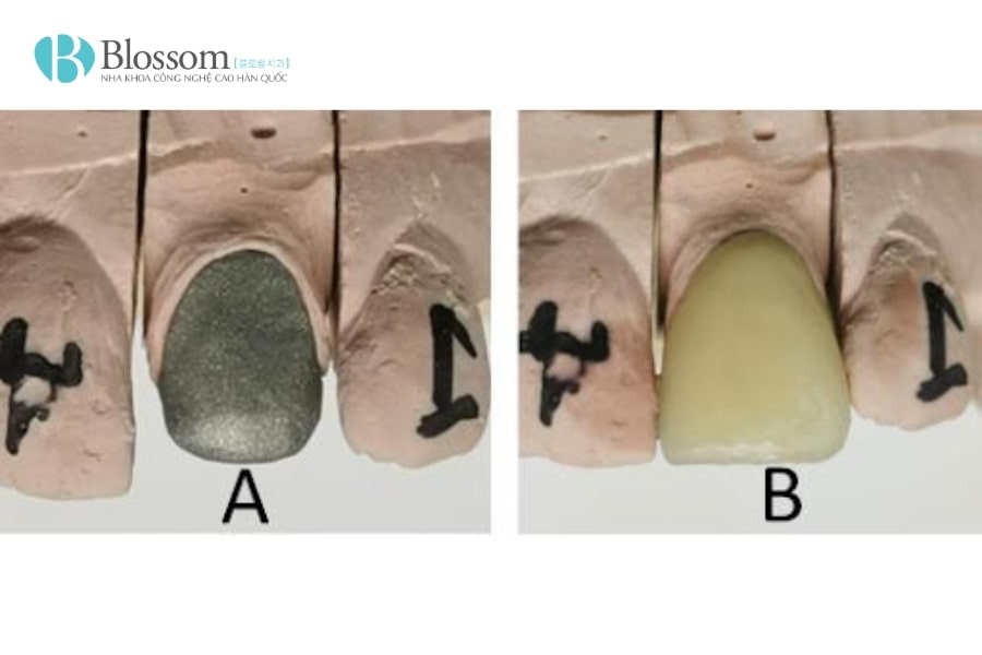 Lịch sử thẩm mỹ răng sứ: Hành trình phát triển từ cổ đại đến hiện đại 1 lich su tham my rang su 1 min