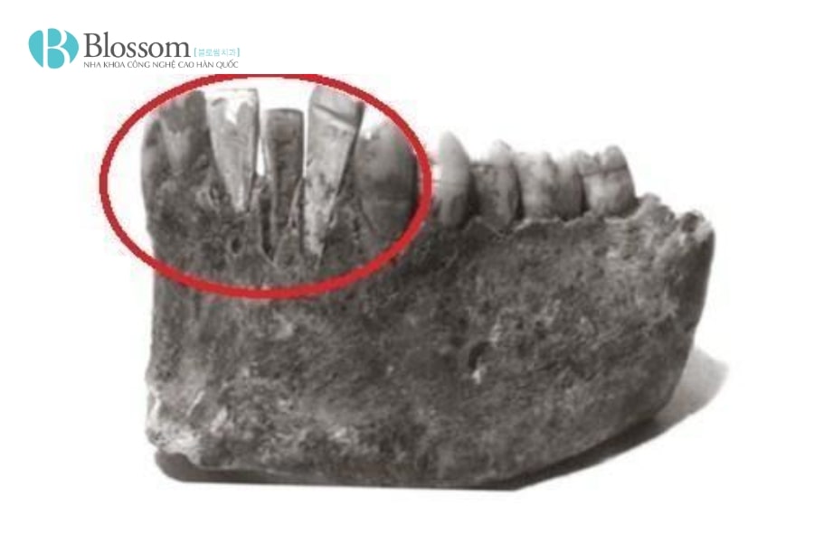 Lịch sử thẩm mỹ răng sứ: Hành trình phát triển từ cổ đại đến hiện đại 2 lich su tham my rang su 2 min