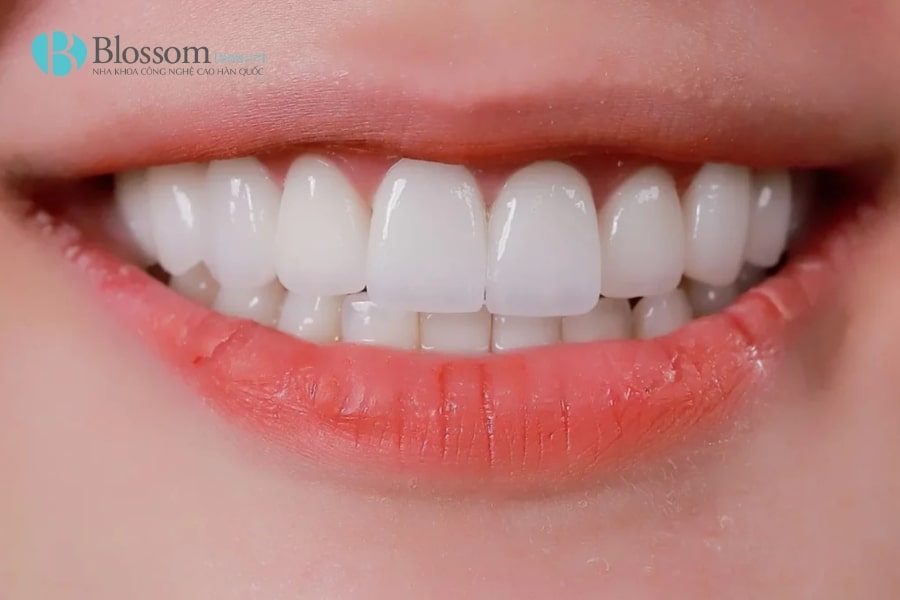 Lịch sử thẩm mỹ răng sứ: Hành trình phát triển từ cổ đại đến hiện đại 7 lich su tham my rang su 7 min