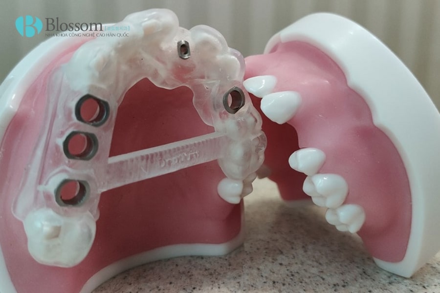 mang huong dan phau thuat 3d 3 min