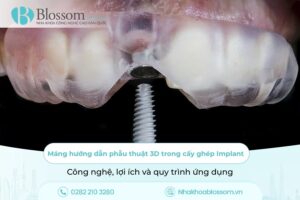 Máng hướng dẫn phẫu thuật 3D trong cấy ghép Implant: Công nghệ, lợi ích và quy trình ứng dụng