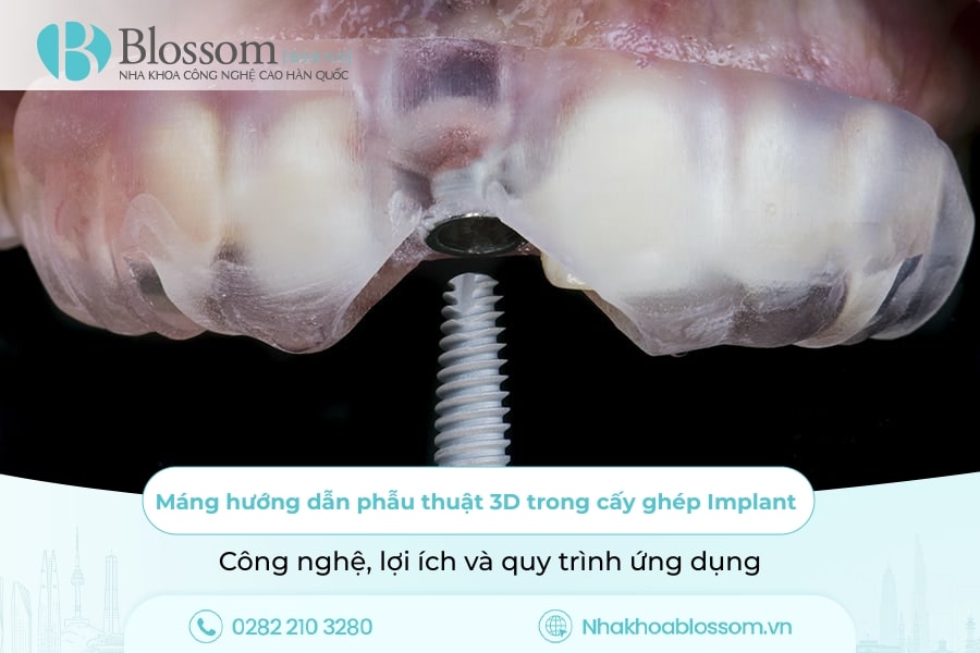 Máng hướng dẫn phẫu thuật 3D trong cấy ghép Implant: Công nghệ, lợi ích và quy trình ứng dụng