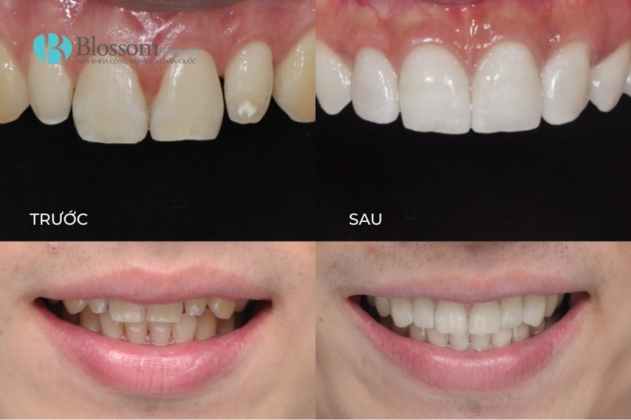 Quy trình dán sứ không mài Lamifilm: Công nghệ phục hình thẩm mỹ 0.1mm độc quyền tại Nha khoa Blossom 2 quy trinh dan su khong mai lamifilm 2 min
