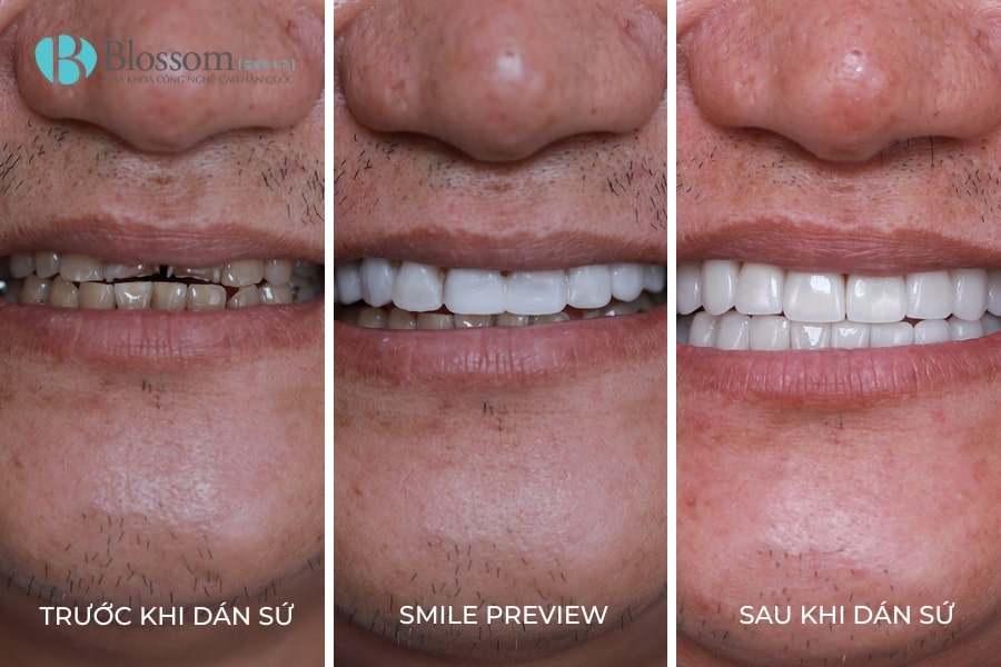 Quy trình dán sứ không mài Lamifilm: Công nghệ phục hình thẩm mỹ 0.1mm độc quyền tại Nha khoa Blossom 4 quy trinh dan su khong mai lamifilm 4 min