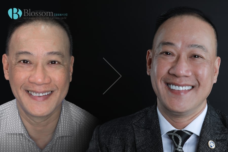 Quy trình dán sứ không mài Lamifilm: Công nghệ phục hình thẩm mỹ 0.1mm độc quyền tại Nha khoa Blossom 5 quy trinh dan su khong mai lamifilm 5 min