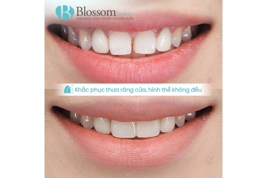 Quy trình dán sứ không mài Lamifilm: Công nghệ phục hình thẩm mỹ 0.1mm độc quyền tại Nha khoa Blossom 6 quy trinh dan su khong mai lamifilm 6 min