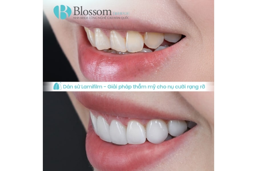 Quy trình dán sứ không mài Lamifilm: Công nghệ phục hình thẩm mỹ 0.1mm độc quyền tại Nha khoa Blossom 8 quy trinh dan su khong mai lamifilm 8 min