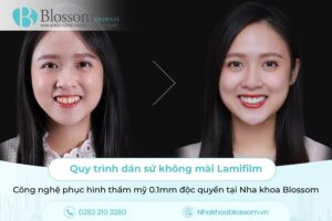 Quy trình dán sứ không mài Lamifilm: Công nghệ phục hình thẩm mỹ 0.1mm độc quyền tại Nha khoa Blossom