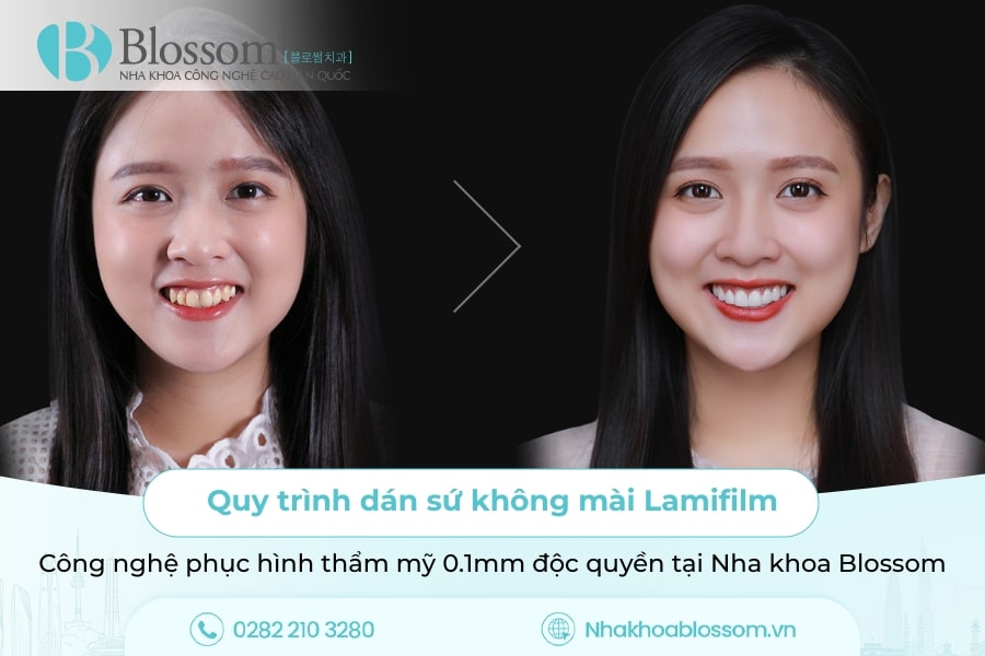 Quy trình dán sứ không mài Lamifilm: Công nghệ phục hình thẩm mỹ 0.1mm độc quyền tại Nha khoa Blossom