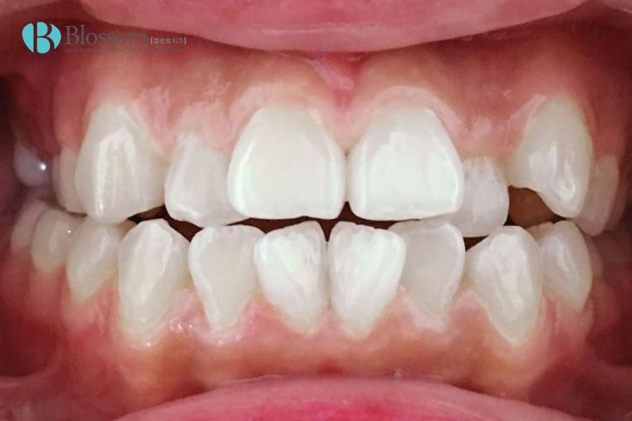 Răng 9630 có nguy hiểm không? Ảnh hưởng đến sức khỏe và thẩm mỹ răng miệng như thế nào? 1 rang 9630 1 min 1