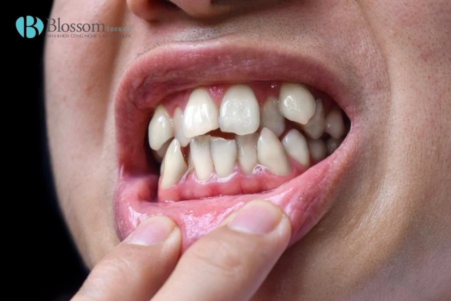 Răng 9630 có nguy hiểm không? Ảnh hưởng đến sức khỏe và thẩm mỹ răng miệng như thế nào? 2 rang 9630 2 min 1