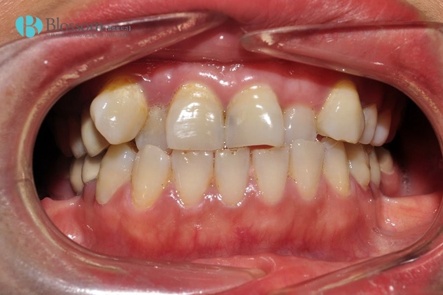 Răng 9630 có nguy hiểm không? Ảnh hưởng đến sức khỏe và thẩm mỹ răng miệng như thế nào? 3 rang 9630 3 min 1