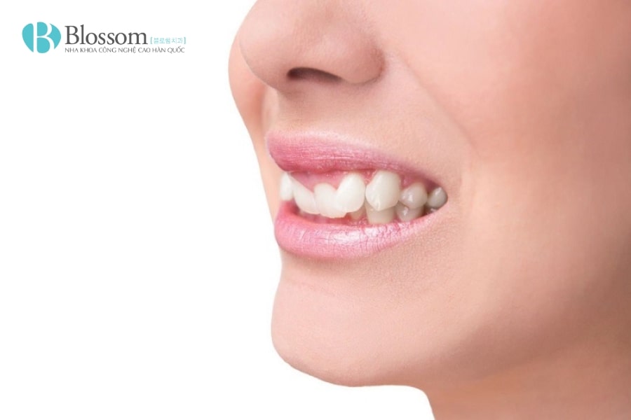 Răng 9630 có nguy hiểm không? Ảnh hưởng đến sức khỏe và thẩm mỹ răng miệng như thế nào? 4 rang 9630 4 min 1