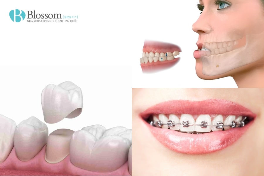 Răng 9630 có nguy hiểm không? Ảnh hưởng đến sức khỏe và thẩm mỹ răng miệng như thế nào? 5 rang 9630 5 min 1