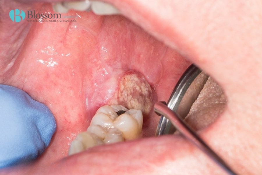 ung thu khoang mieng 1 min