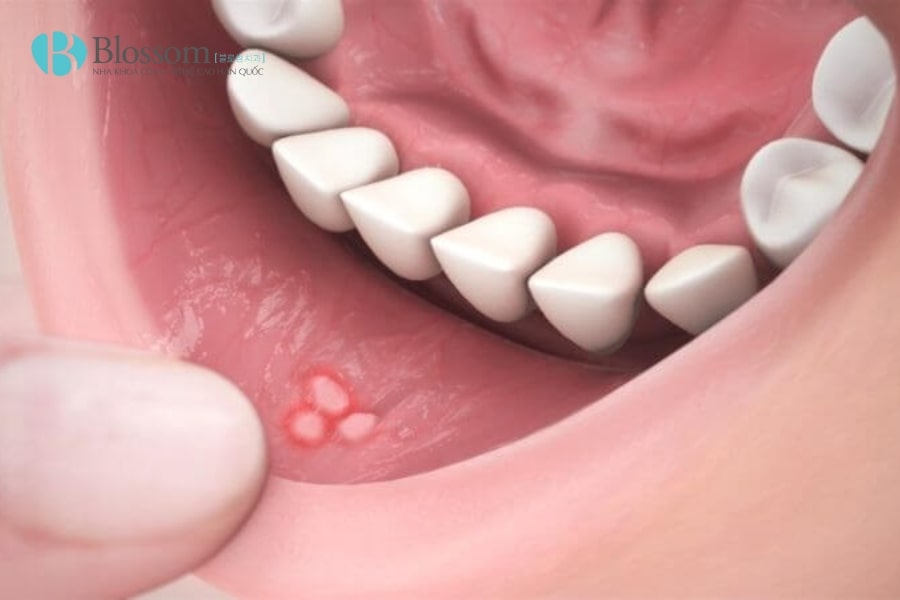 ung thu khoang mieng 2 min