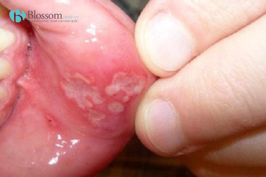 ung thu khoang mieng 3 min