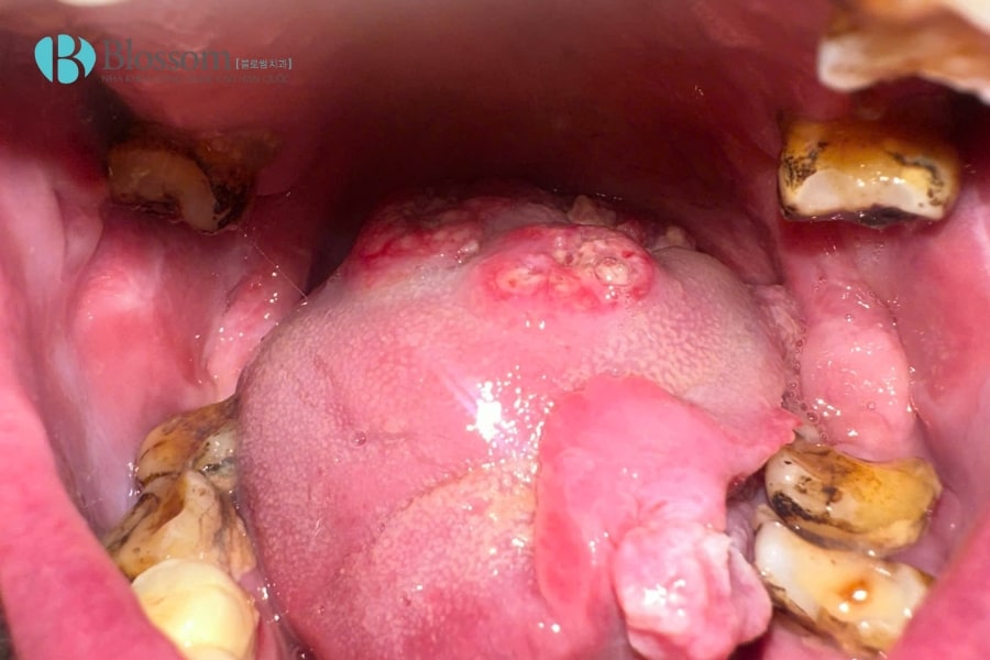 ung thu khoang mieng 4 min