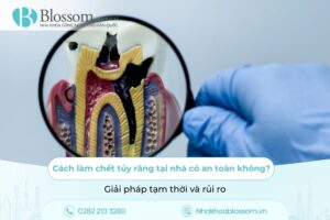 Cách làm chết tủy răng tại nhà có an toàn không? Giải pháp tạm thời và rủi ro
