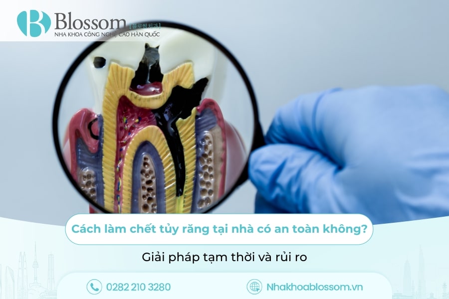 Cách làm chết tủy răng tại nhà có an toàn không? Giải pháp tạm thời và rủi ro