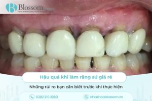 Hậu quả khi làm răng sứ giá rẻ: Những rủi ro bạn cần biết trước khi thực hiện