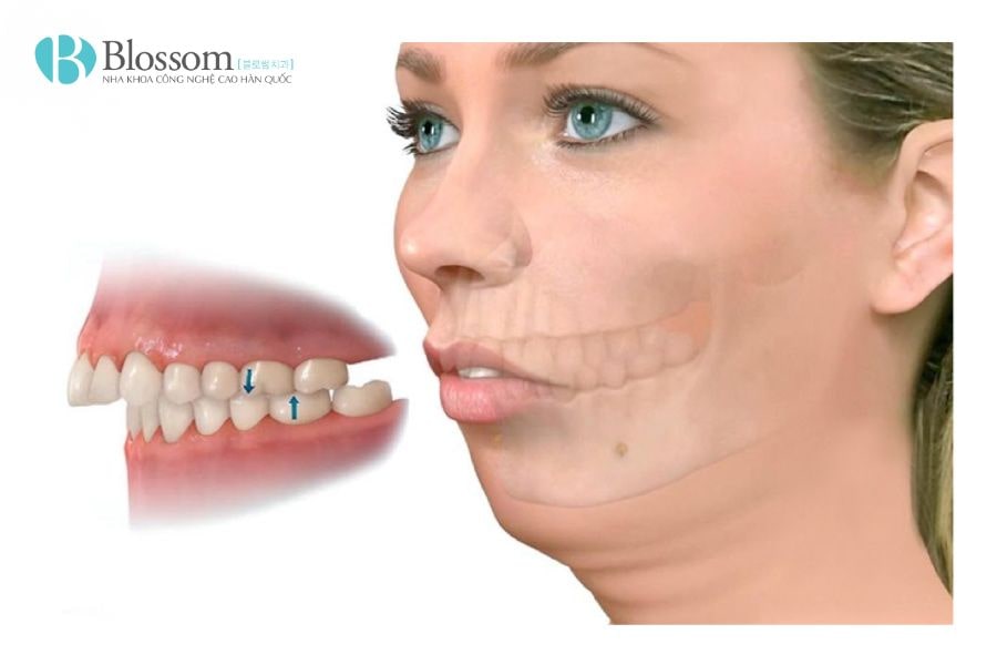 boc rang su co het ho 1 min