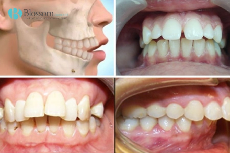 boc rang su co het ho 4 min