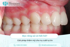 Bọc răng sứ có hết hô? Giải pháp thẩm mỹ cho nụ cười tự tin