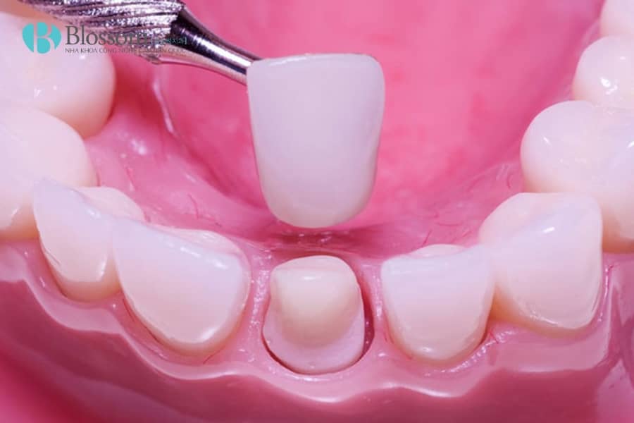 Bọc răng sứ không mài có được không? Hiểu đúng về mài răng và giải pháp thẩm mỹ không xâm lấn 1 boc rang su khong mai co duoc khong 1 min