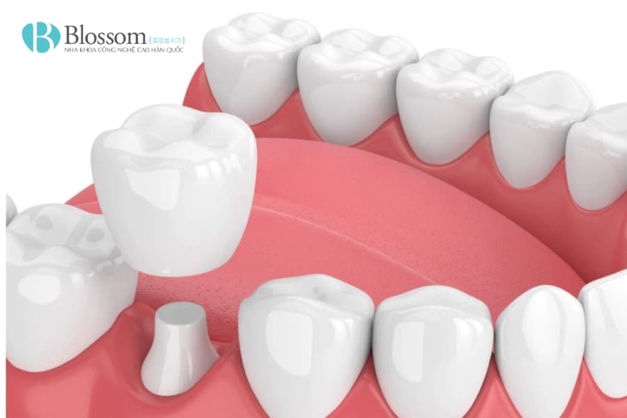 Bọc răng sứ không mài có được không? Hiểu đúng về mài răng và giải pháp thẩm mỹ không xâm lấn 2 boc rang su khong mai co duoc khong 2 min