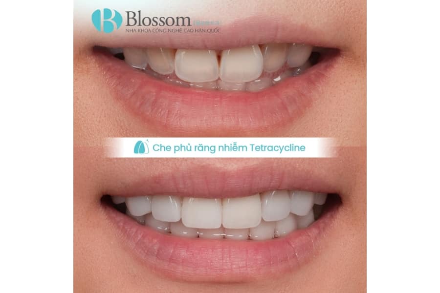 Bọc răng sứ không mài có được không? Hiểu đúng về mài răng và giải pháp thẩm mỹ không xâm lấn 5 boc rang su khong mai co duoc khong 5 min