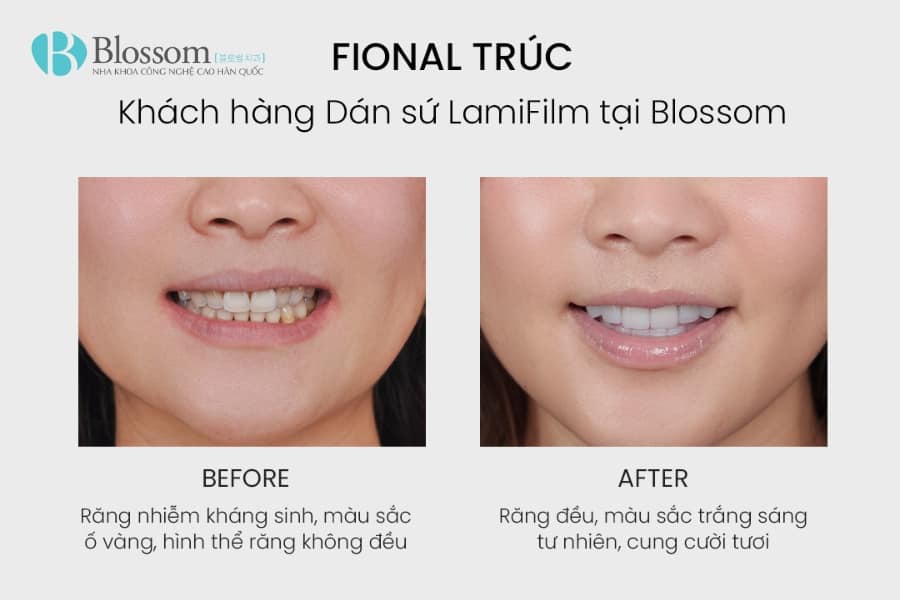 Bọc răng sứ không mài có được không? Hiểu đúng về mài răng và giải pháp thẩm mỹ không xâm lấn 6 boc rang su khong mai co duoc khong 6 min