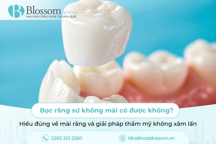 Bọc răng sứ không mài có được không? Hiểu đúng về mài răng và giải pháp thẩm mỹ không xâm lấn