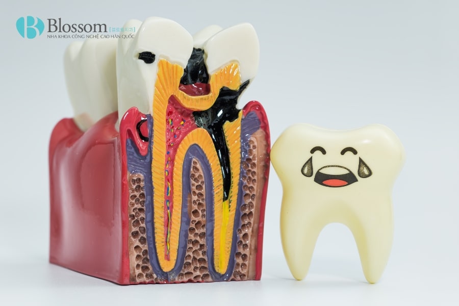 Cách làm chết tủy răng tại nhà có an toàn không? Giải pháp tạm thời và rủi ro 1 cach lam chet tuy rang tai nha 1 min