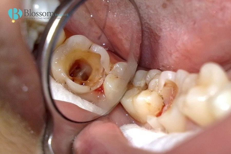 Cách làm chết tủy răng tại nhà có an toàn không? Giải pháp tạm thời và rủi ro 3 cach lam chet tuy rang tai nha 3 min