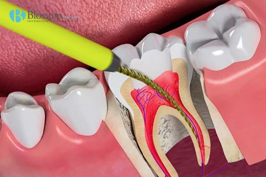 Cách làm chết tủy răng tại nhà có an toàn không? Giải pháp tạm thời và rủi ro 5 cach lam chet tuy rang tai nha 5 min